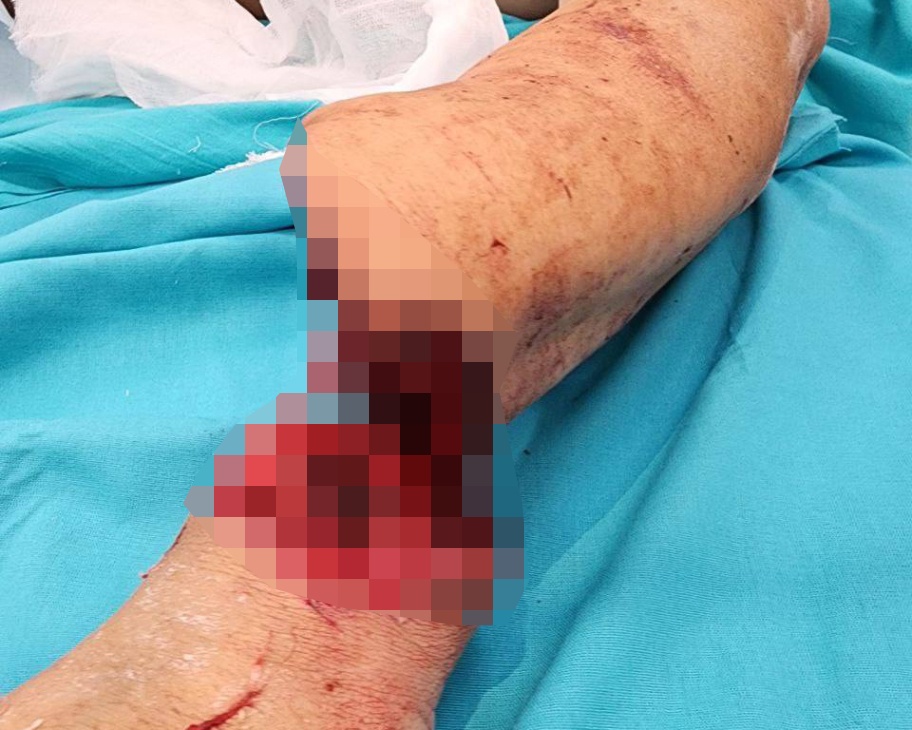 Нижегородские хирурги восстановили мужчине руку, отрезанную дисковой пилой - фото 1