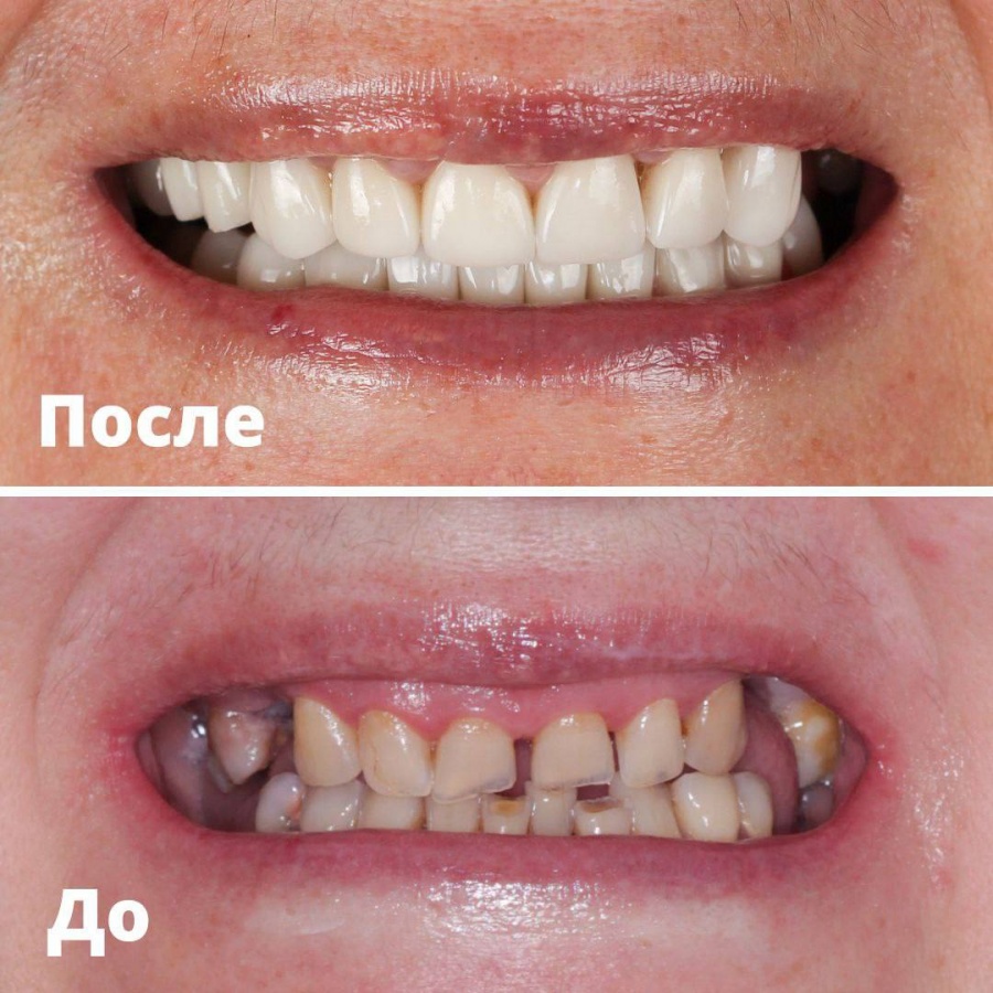 Ликвидируем пробелы: 8 вопросов о восстановлении красивых зубов - фото 3